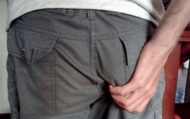 itching in the anus as a symptom of the presence of parasites