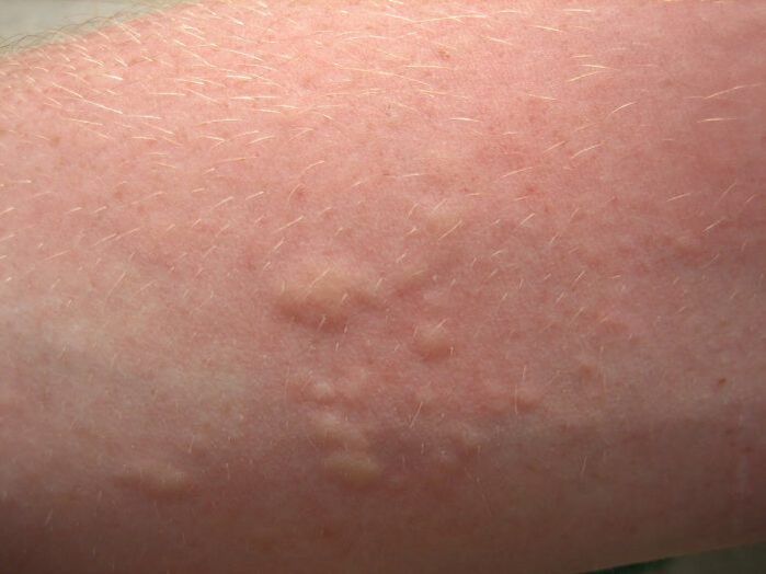 itchy allergic skin rashes may be symptoms of ascariasis