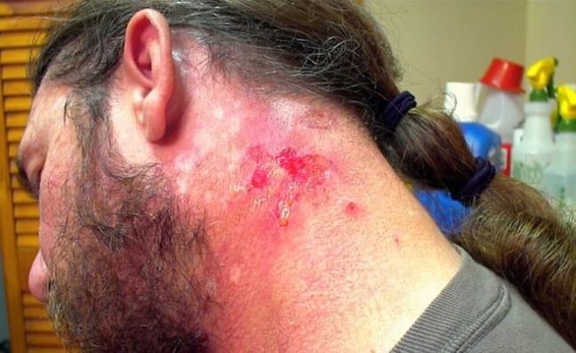 Bleeding wound on the neck with Morgellons virus