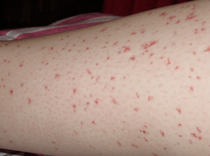 A skin rash is a sign of an acute stage worm infection