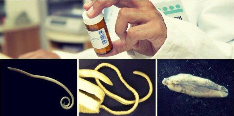 Types of worms and medical methods for their removal
